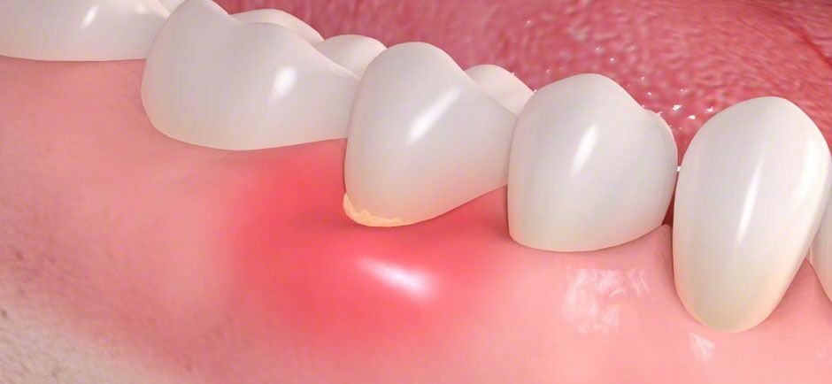 Gum Disease Management