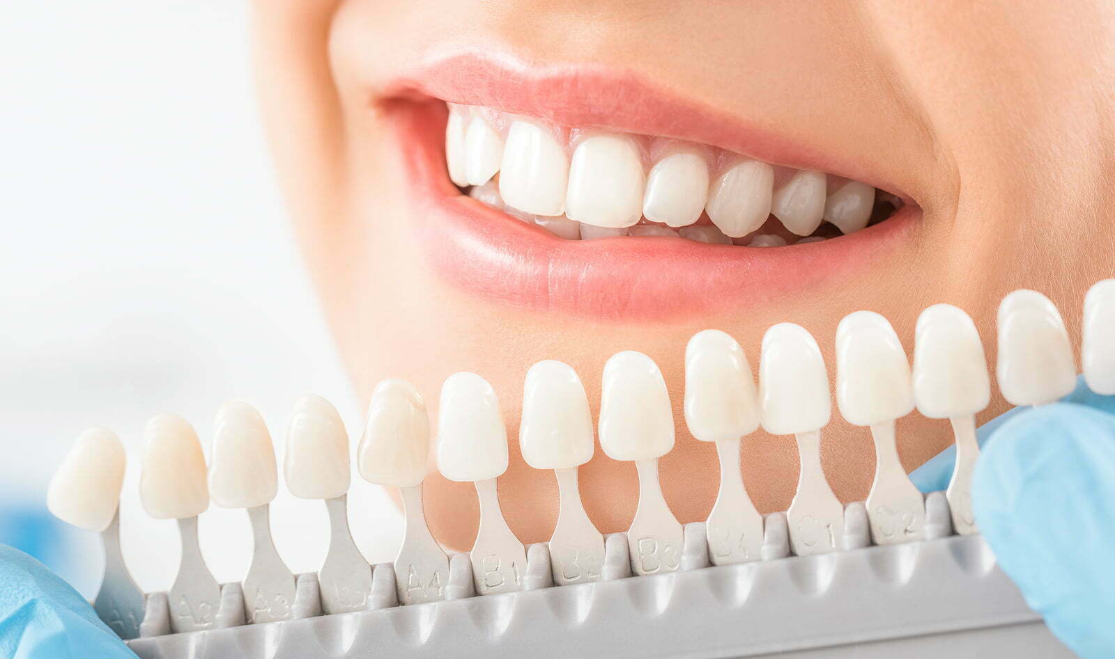 Teeth Whitening