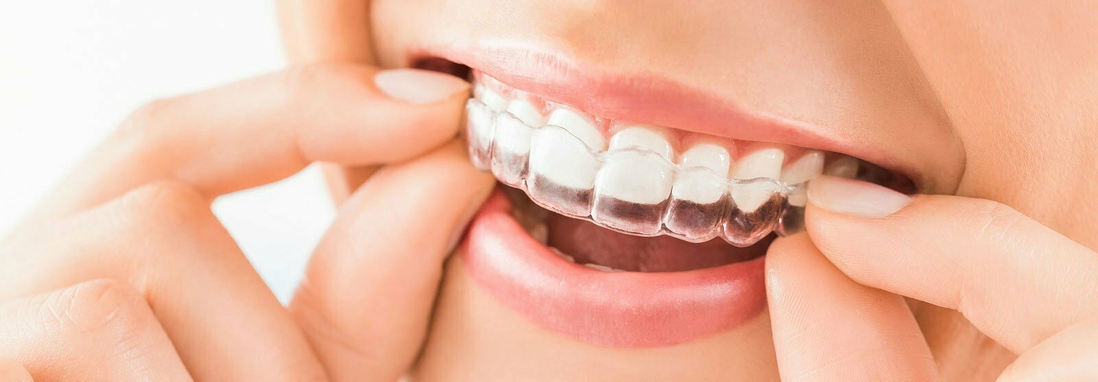 Invisalign Invisible Braces